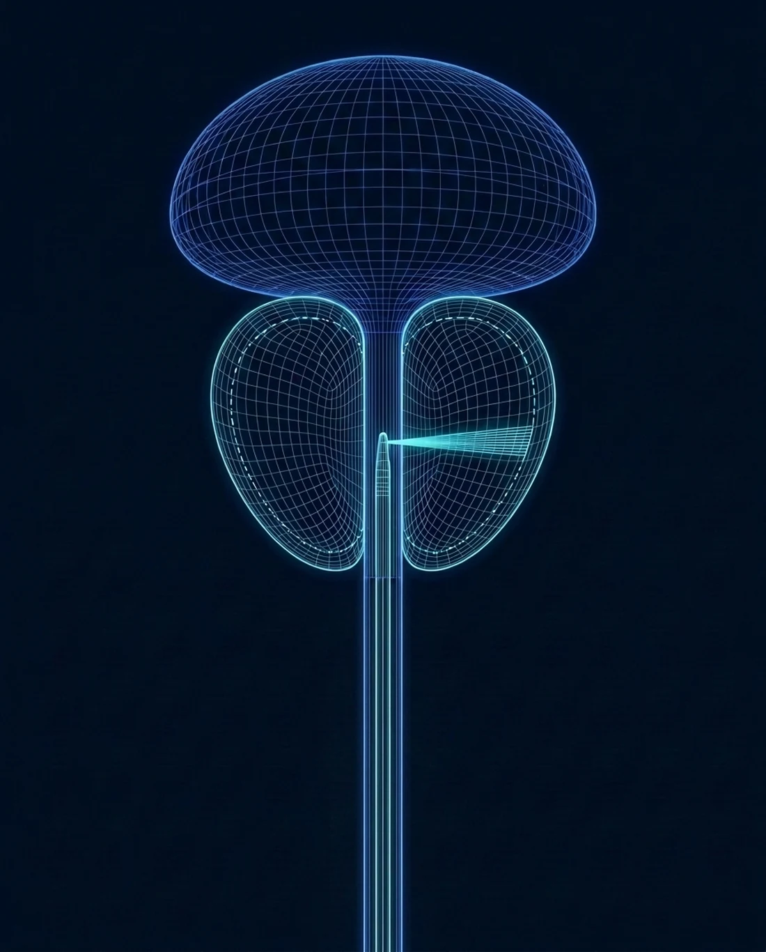 A contour-line cross-section of the bladder and prostate showing the robotic handpiece in the urethra, a fan-shaped waterjet, and the dashed planned treatment boundary