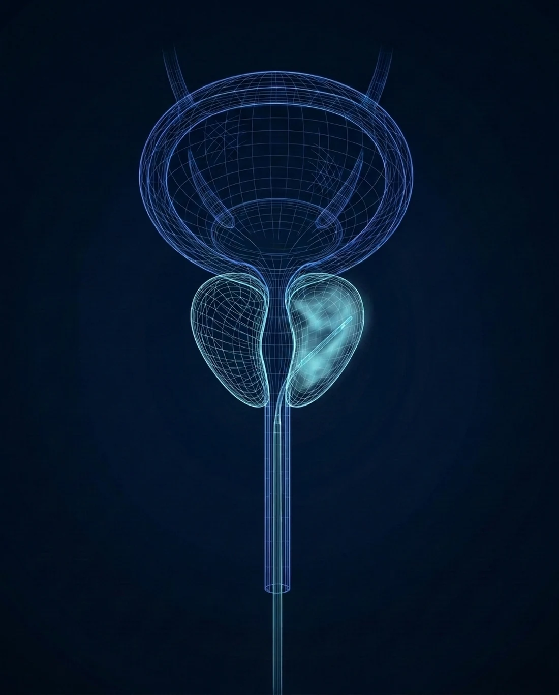 A contour-line rendering of the bladder and prostate with a needle releasing water vapor into the prostate tissue
